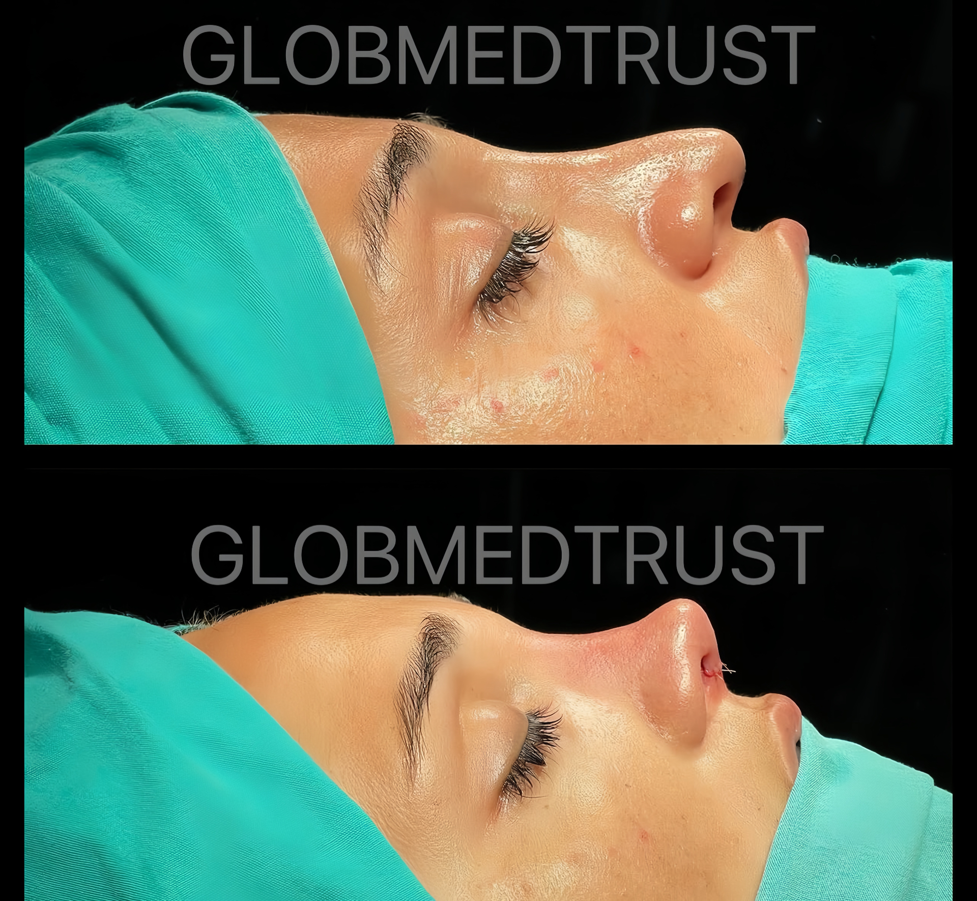 GlobMedTrust rhinoplasty before and after — refined nasal profile, natural results from an experienced Istanbul surgeon