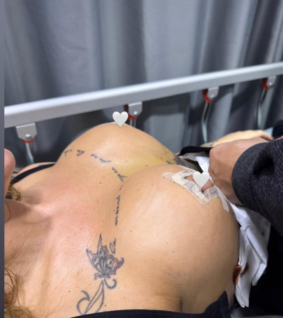 Mastopexy (Breast Lift) result 1