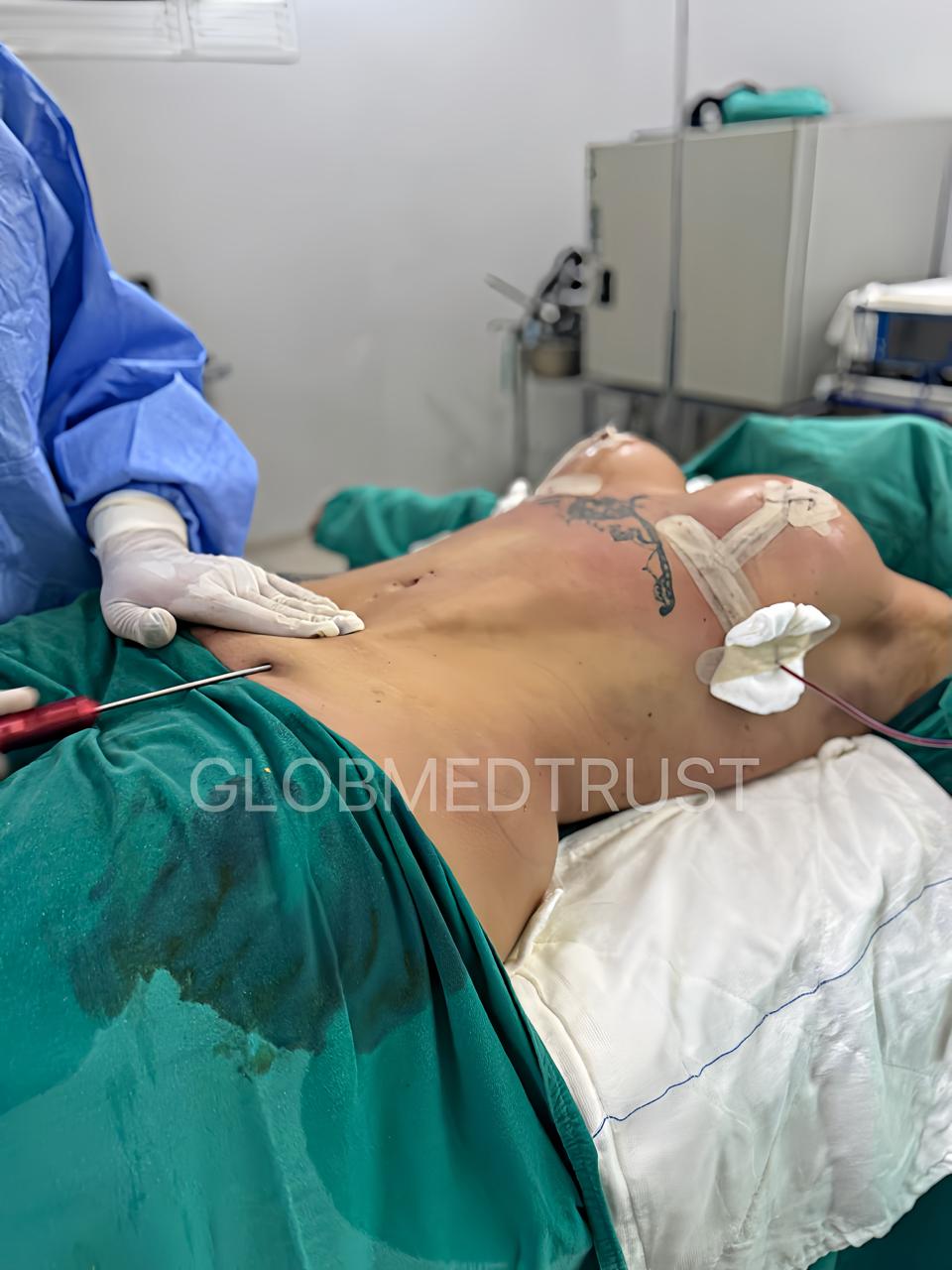 Mastopexy (Breast Lift) result 2