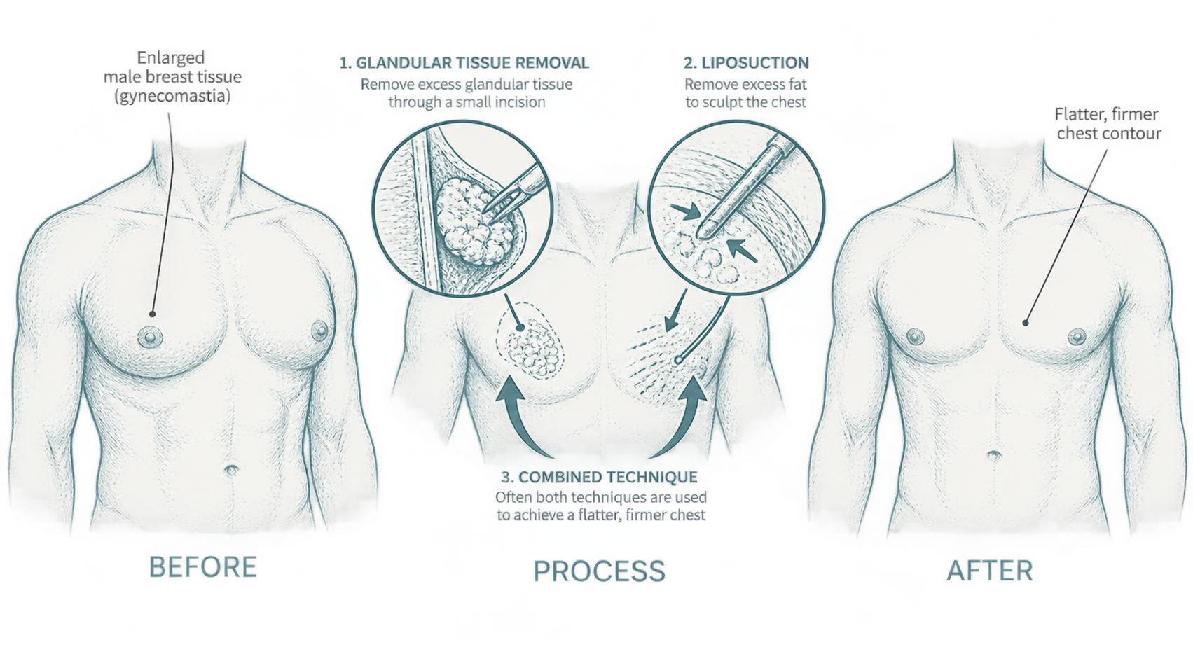 Before, process, and after gynecomastia surgery sketch showing enlarged male breast tissue, glandular tissue removed through a small incision, liposuction of excess fat, both techniques combined, and a flatter, firmer chest